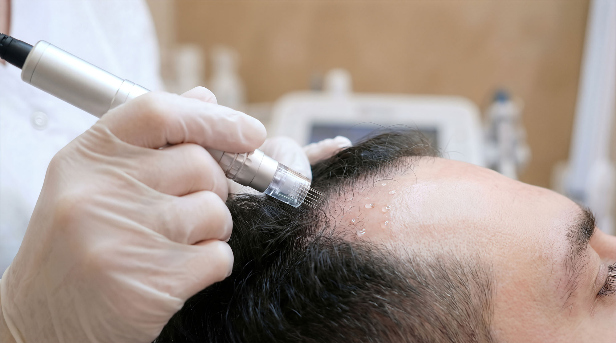 Microneedling scalp Willow Primary Care Vero Beach